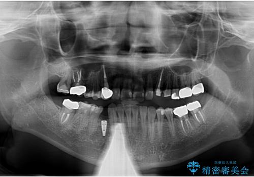 歯並びと虫歯(メタルフリー)を行った全顎治療の治療中