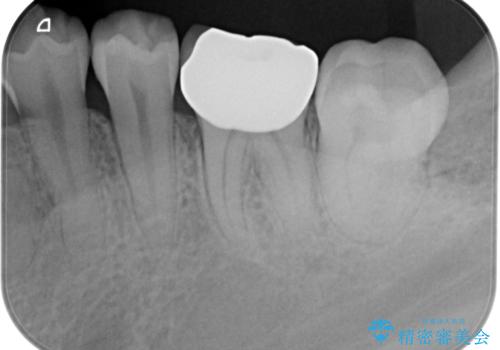 歯冠長延長術をおこなったアプローチの難しい虫歯治療の治療後