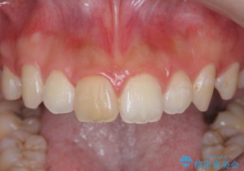 前歯の変色をキレイに セラミッククラウン審美治療の治療前