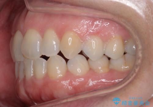 矮小(わいしょう)歯の形をセラミックで自然に 50代女性の治療前