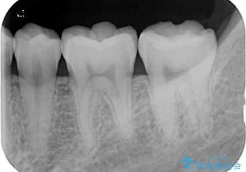 奥歯を綺麗にしたいの治療後