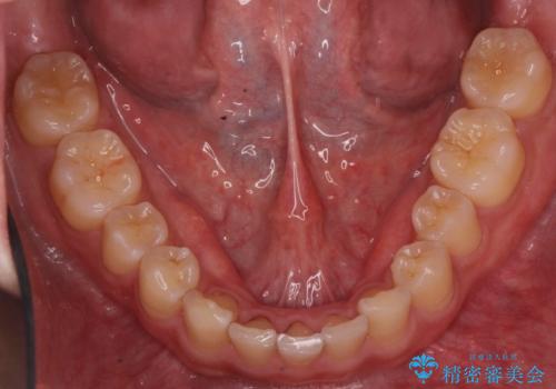 前歯のすき間　小さい歯がある　前歯の並びをきれいにしたいの治療後