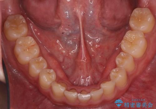 前歯のすき間 小さい歯がある 前歯の並びをきれいにしたいの治療後