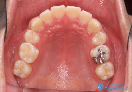 抜歯矯正の長期予後(術後8年目)の治療中