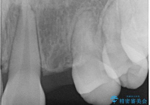 前歯の審美的なブリッジ (歯列矯正後)の治療前