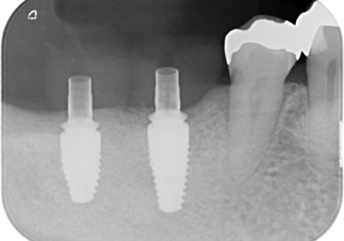 大臼歯　2本インプラントで自分の歯と同じくらい噛めるようにの治療中