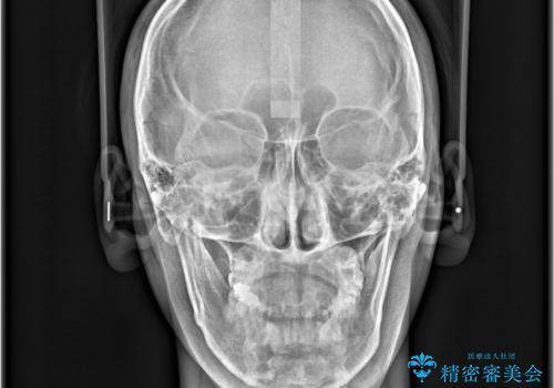 【インビザライン 非抜歯】歯の捻じれと歯のでこぼこを治したい!の治療前