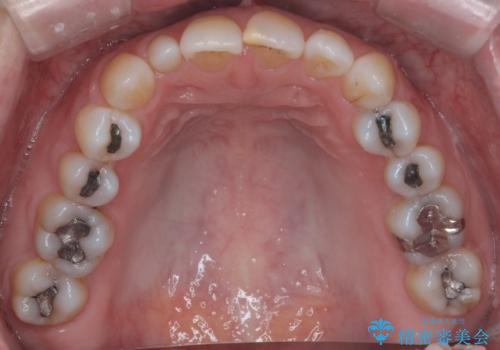 矮小(わいしょう)歯の形をセラミックで自然に 50代女性の治療前