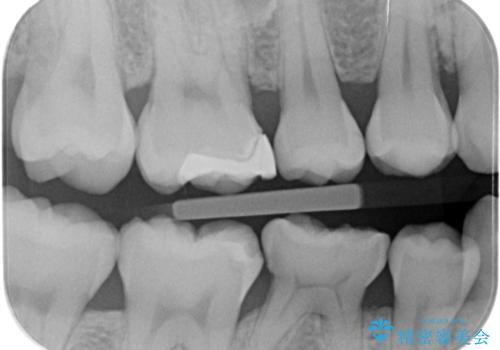 歯が染みる。　セラミックインレー治療。の治療前