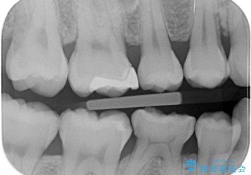 歯が染みる。セラミックインレー治療。の治療前