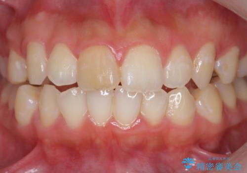 前歯の変色をキレイに セラミッククラウン審美治療の治療前