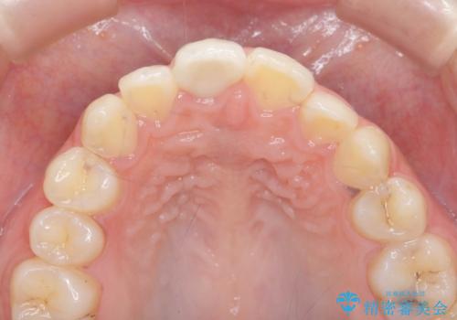 前歯の変色をキレイに セラミッククラウン審美治療の治療後