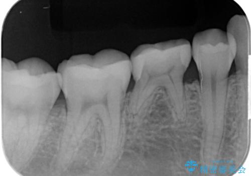 歯が染みる。セラミックインレー治療。の治療後