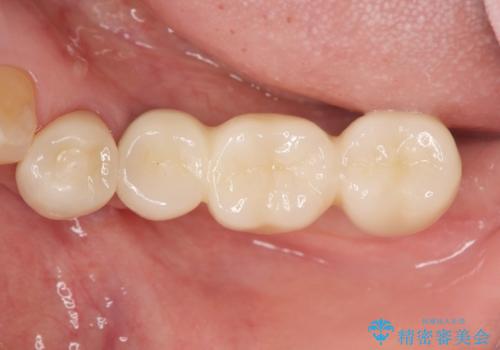 チタンカスタムアバットメントを用いた清掃性の高いインプラント治療の治療後