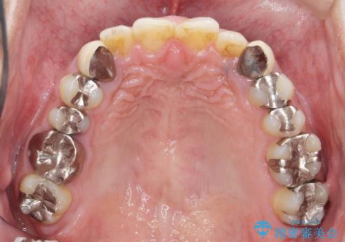 歯並びと虫歯(メタルフリー)を行った全顎治療の治療前