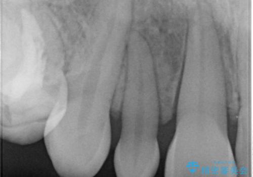 前歯の審美的なブリッジ (歯列矯正後)の治療前