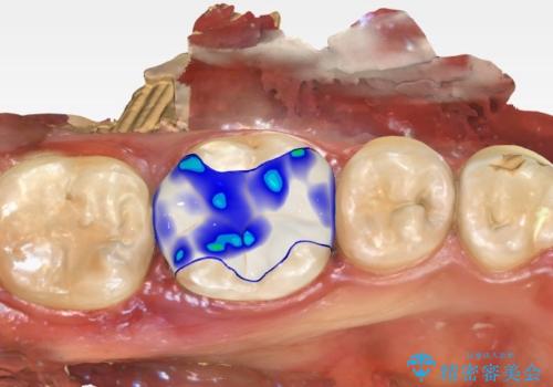 他院で治療した歯がしみる　歯髄を守る即日セラミックインレーへの治療中
