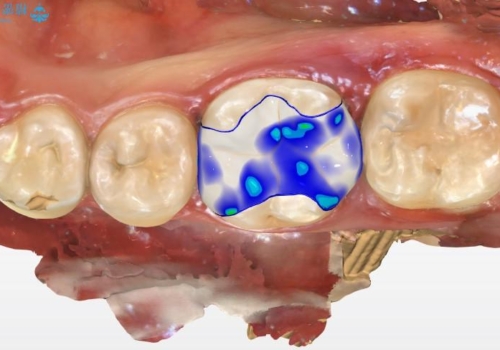 他院で治療した歯がしみる 歯髄を守る即日セラミックインレーへの治療中