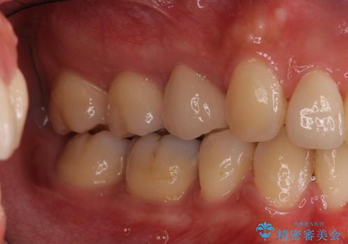 重度のがたつき 矯正治療+セラミック治療で綺麗な歯並びに 矯正専門では難しい治療の治療後