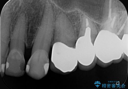 【セラミッククラウン】昔入れた被せものの黒いところが気になるの治療後