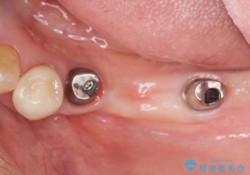チタンカスタムアバットメントを用いた清掃性の高いインプラント治療の治療中