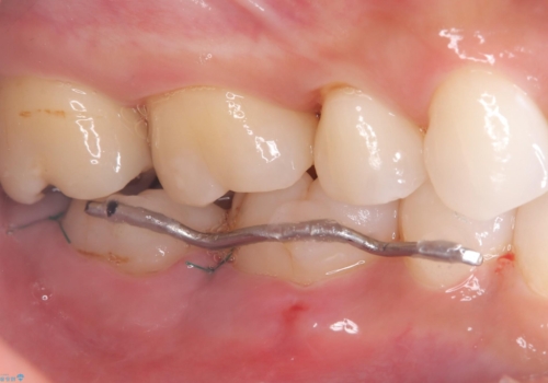 【再生療法】急に歯茎がすごく痛くなったの治療後