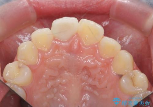 前歯の変色をキレイに セラミッククラウン審美治療の治療後