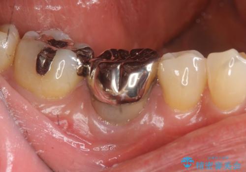 目立つ銀歯を除去したい メタルフリー治療の希望の治療前