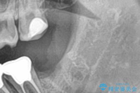 まっすぐ生えた親知らず抜歯の症例 治療後