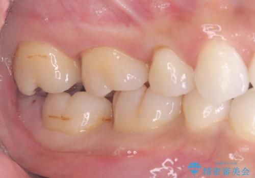 【再生療法】急に歯茎がすごく痛くなったの治療前