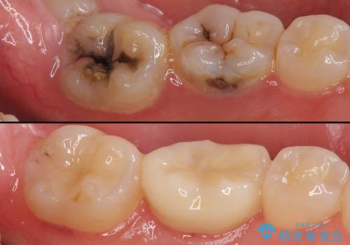 歯冠長延長術をおこなったアプローチの難しい虫歯治療