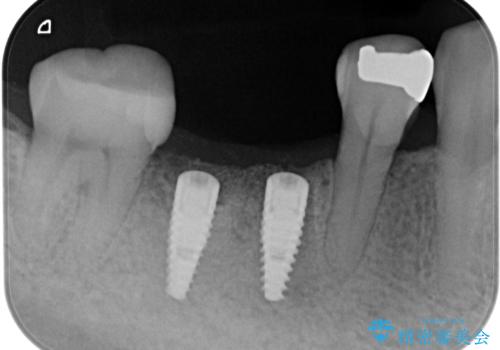 歯槽堤保存術 → インプラント治療の治療中