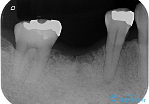 歯槽堤保存術 → インプラント治療の治療後