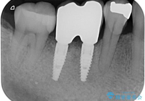 歯槽堤保存術 → インプラント治療の治療後