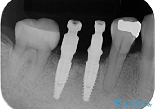 歯槽堤保存術 → インプラント治療の治療中