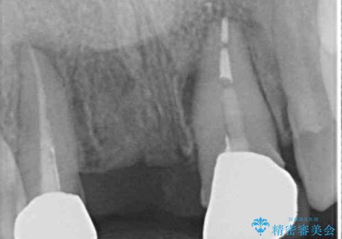 矯正治療中の仮歯を治したい オールセラミックブリッジ補綴治療の治療前