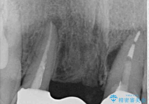 矯正治療中の仮歯を治したい オールセラミックブリッジ補綴治療の治療後