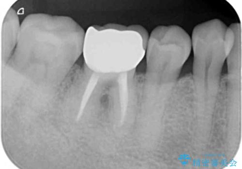 目立つ銀歯を除去したい メタルフリー治療の希望の治療後