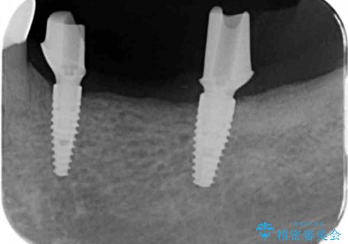 チタンカスタムアバットメントを用いた清掃性の高いインプラント治療の治療中