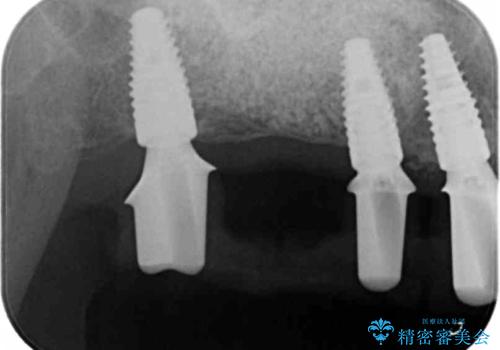 歯周病で失った歯をインプラント治療で咬合機能回復の治療中