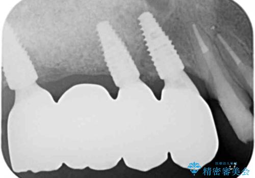 歯周病で失った歯をインプラント治療で咬合機能回復の治療後