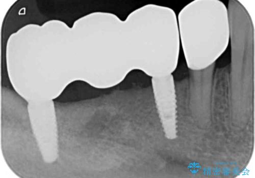 歯周病で失った歯をインプラント治療で咬合機能回復の治療後