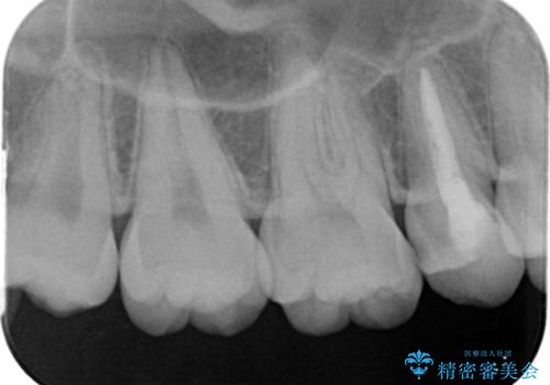 奥歯の神経のない歯をセラミックでしっかり治療の治療前