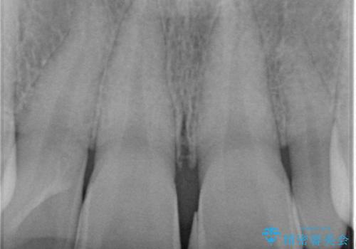 つぎはぎだらけの前歯を周囲と調和させたい　オールセラミッククラウン補綴治療の治療前