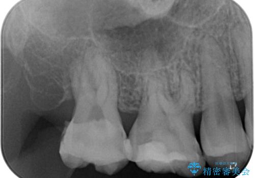 奥歯が痛い オールセラミッククラウンでのむし歯治療の治療前