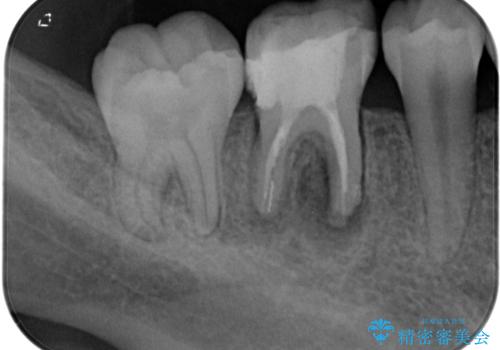 奥歯が痛い オールセラミッククラウンでのむし歯治療の治療前
