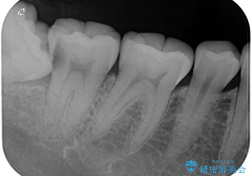親知らずに影響で大きなむし歯に セラミッククラウンによるむし歯治療の治療前