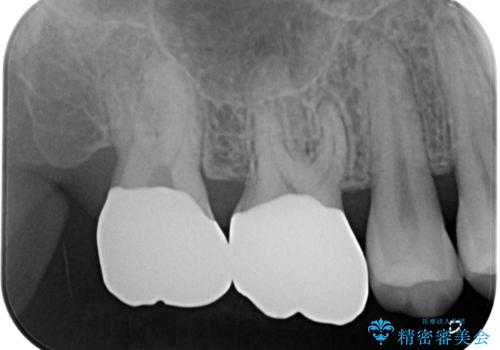 奥歯が痛い　オールセラミッククラウンでのむし歯治療の治療後