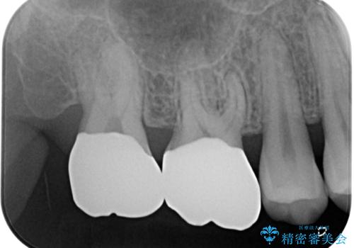 奥歯が痛い オールセラミッククラウンでのむし歯治療の治療後