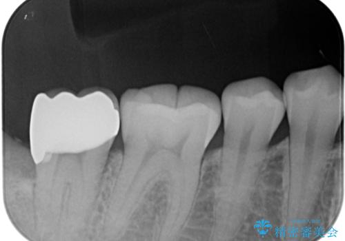 親知らずに影響で大きなむし歯に　セラミッククラウンによるむし歯治療の治療後
